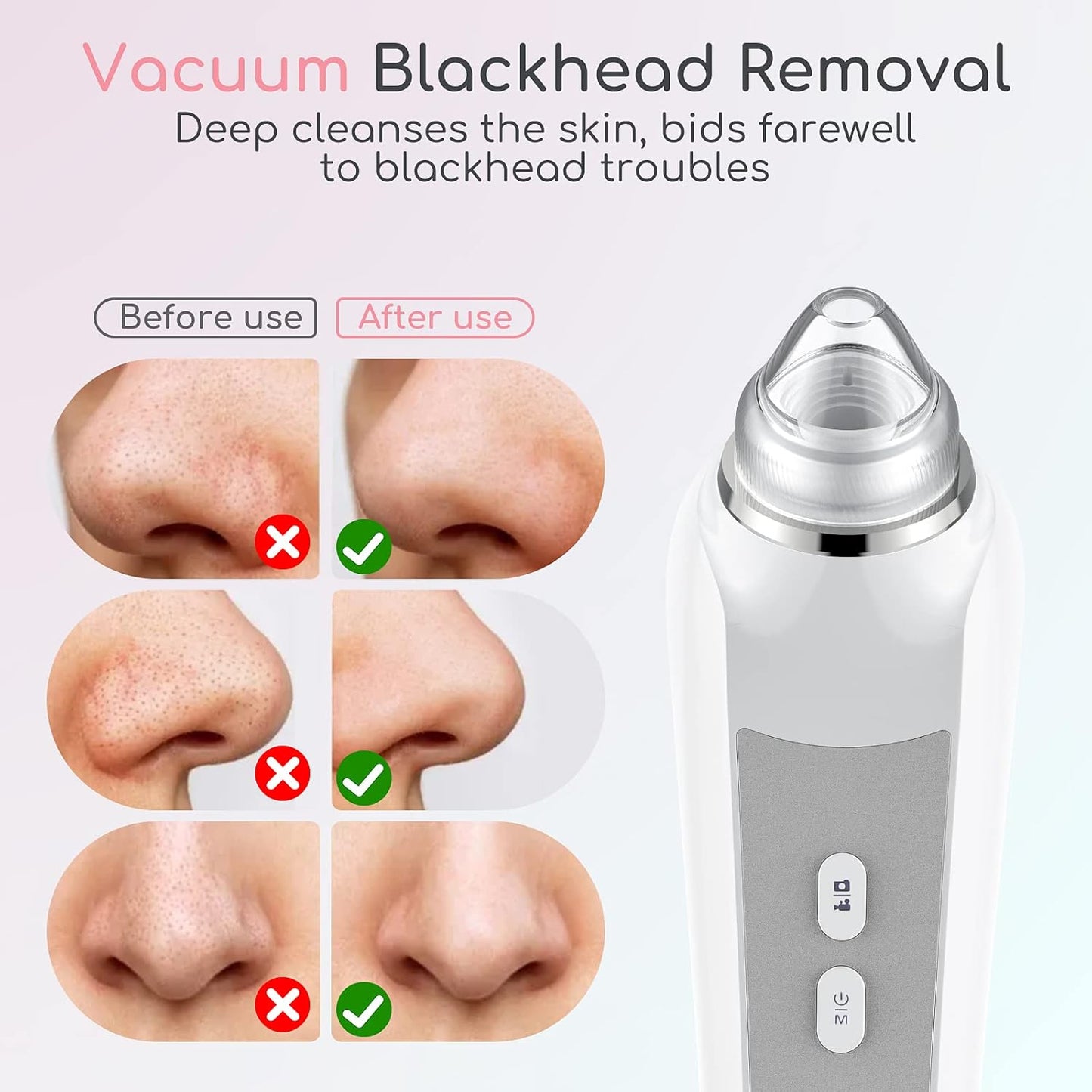 Vacuum Blackhead Removal