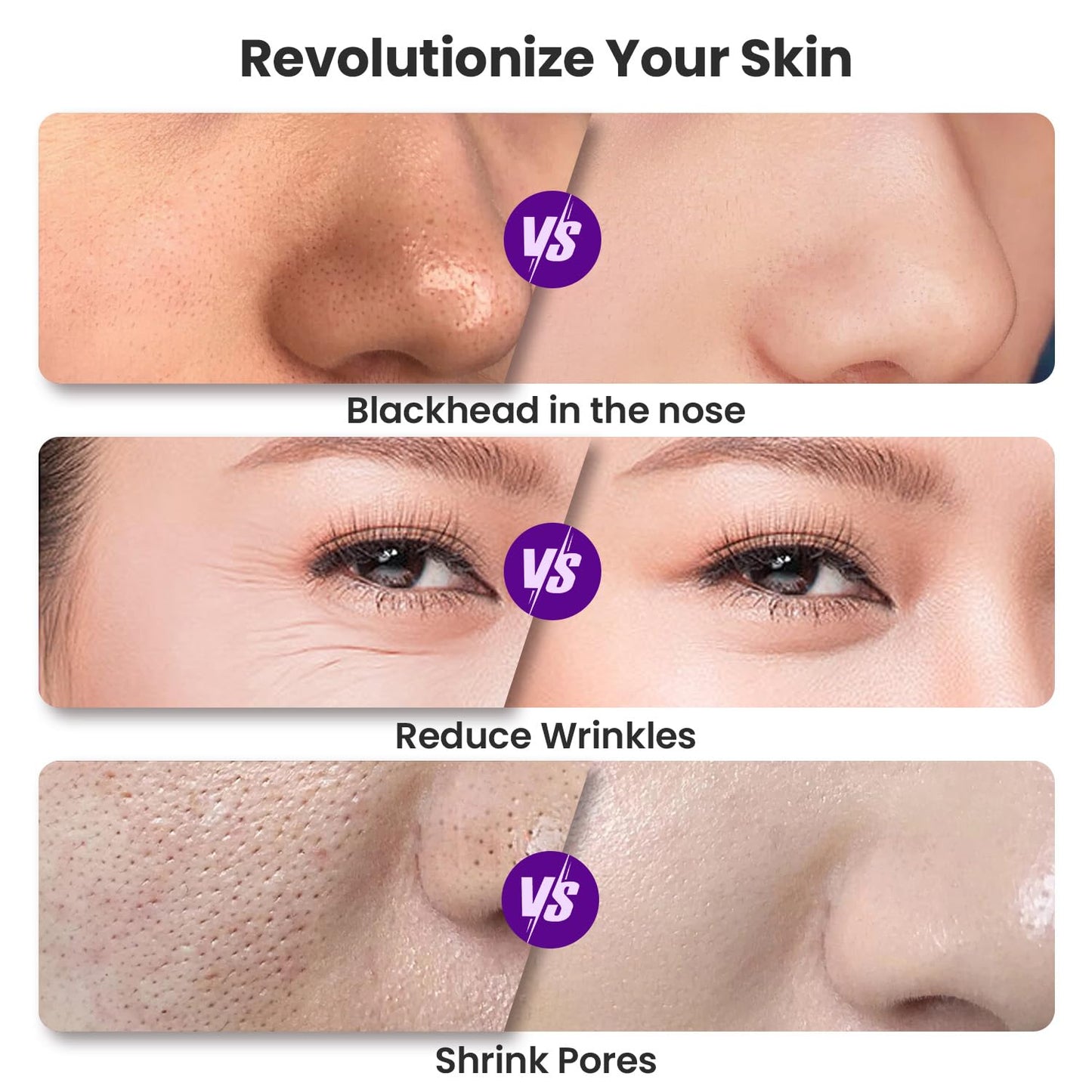 Unoisetion Microdermabrasion Machine