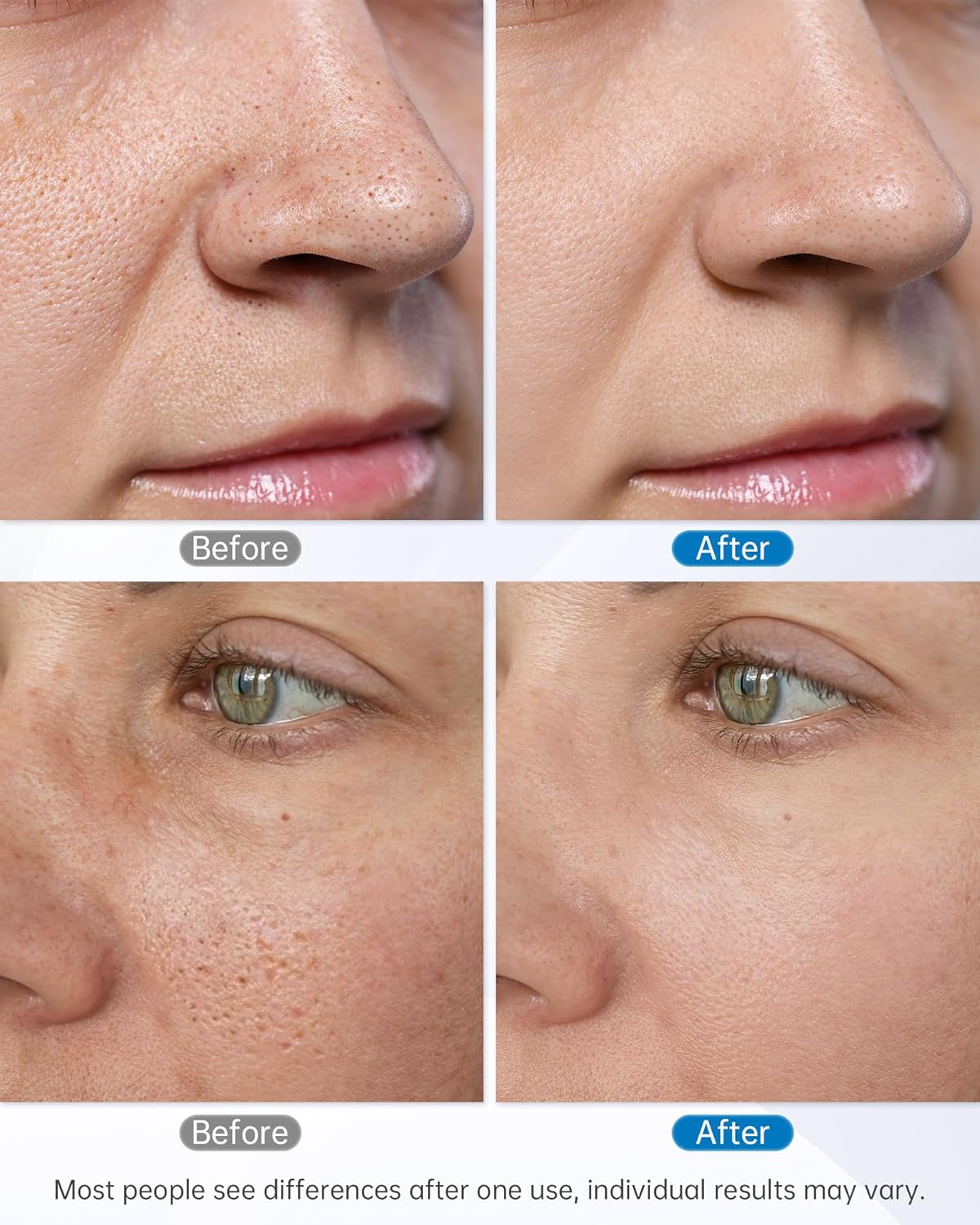 Unoisetion At-home Microdermabrasion