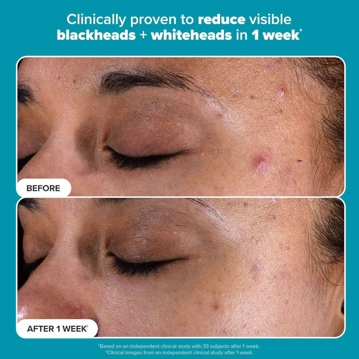Paula's Choice Skin Perfecting 2% BHA Exfoliating Toner Pads