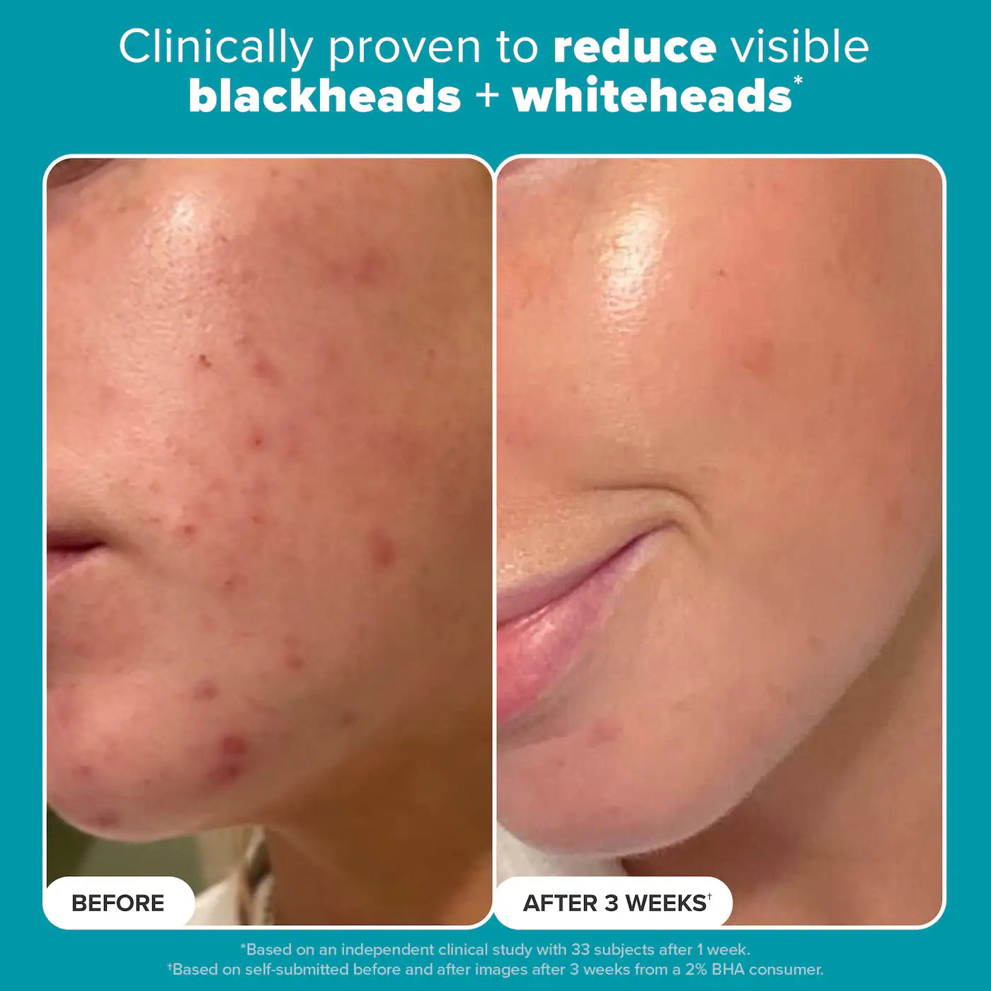 Paula's Choice Skin Perfecting 2% BHA Exfoliating Toner Pads